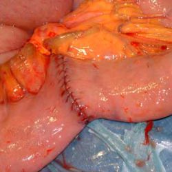 Small intestine after being rejoined surgically.