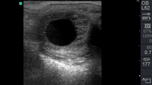 Ultrasound scan of a pregnant uterus