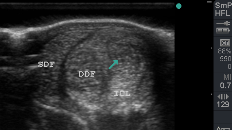 Tendon scan showing flexor tendons and check ligament