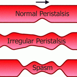 Diagram showing abnormal gut motility